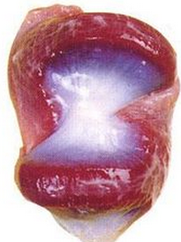 口腔溃疡病因分解与治疗