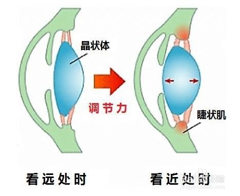 孩子近视了有办法恢复吗