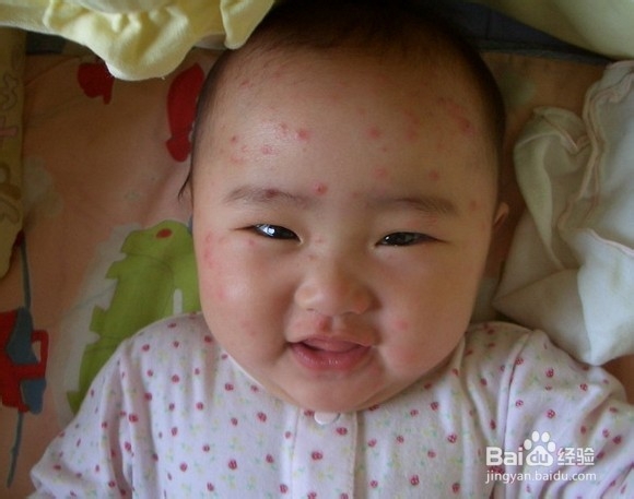 小孩子起水痘怎么办