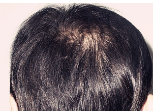 侧柏叶养发水治好了我的脂溢性脱发