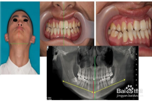如何分辨髁突肥大