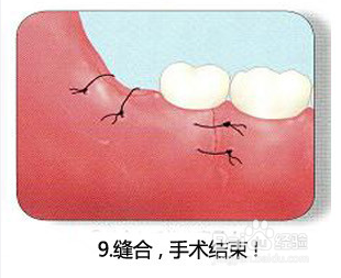 长智齿需要拔掉,医生究竟是怎样拔智齿的呢