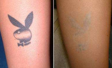 纹身后悔了怎么办