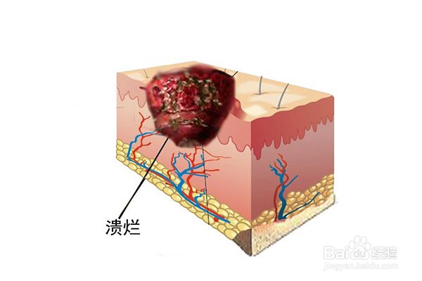 褥疮伤口不同颜色处理方法