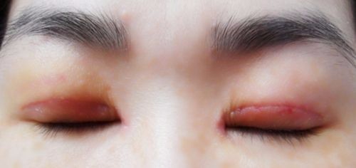 内双能割双眼皮吗