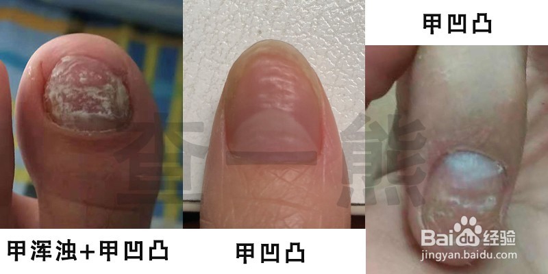 孙叔公灰指甲治疗手册