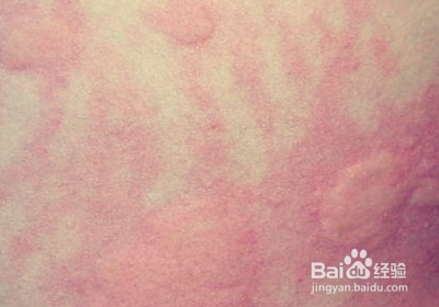 风疙瘩最快的止痒方法