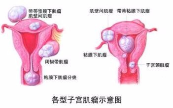 什么是妇科炎症