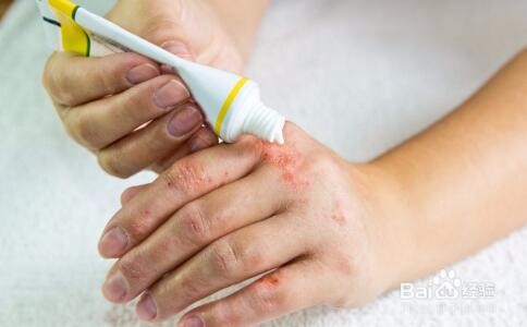 得了湿疹还能根治吗