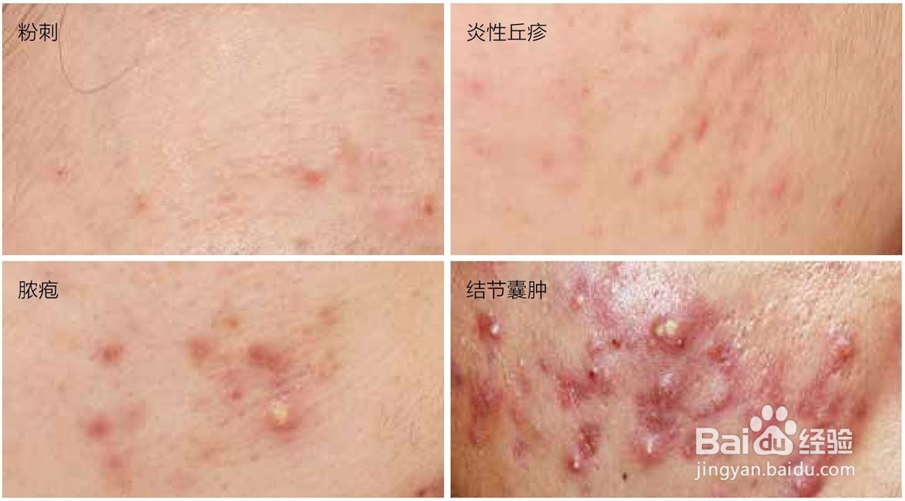 痘痘能挤吗