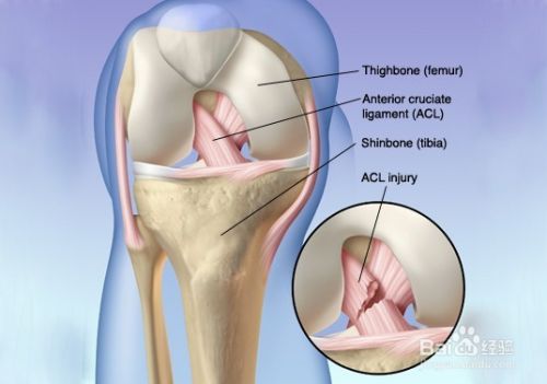 前十字交叉韧带断裂手术后如何复建 Acl 百度经验