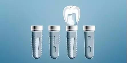 种植牙过程分为几个步骤