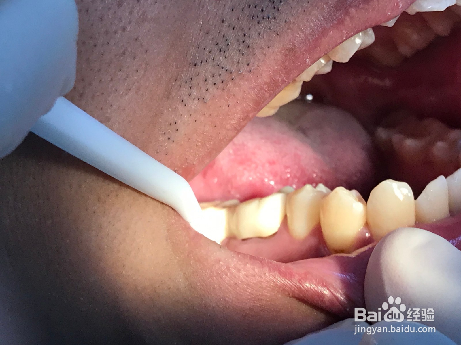 牙齿蛀牙龋齿防止