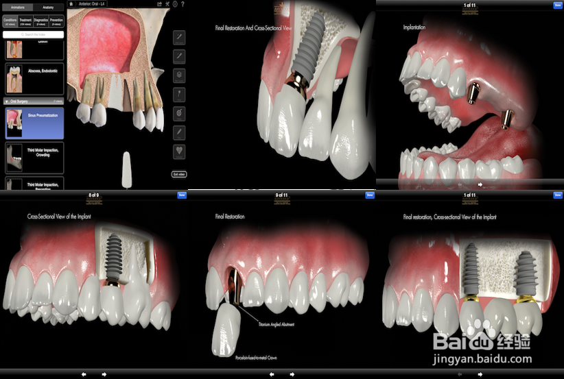 牙齿缺失|数字化种植牙与传统种植牙的区别