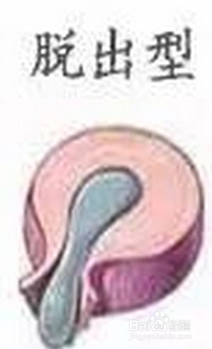 解决椎间盘突出症状的三个要点及误区