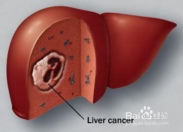 常见内科病之传染病治疗方法：[4]病毒肝炎