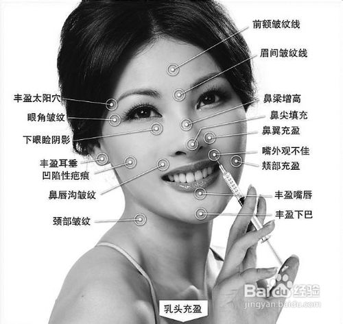 注射爱贝芙(Artecoll)安全吗