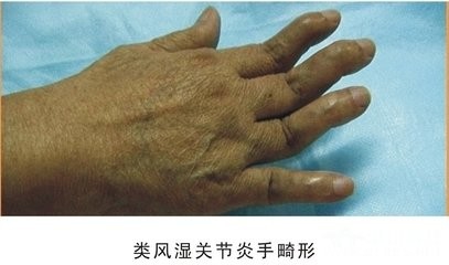 如何用食物治疗风湿病