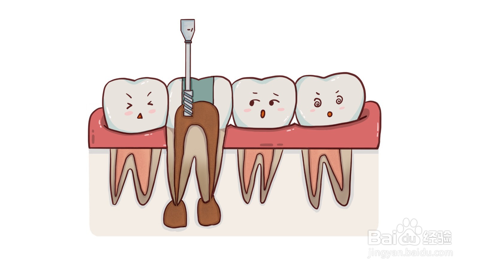 什么是根管治疗？有什么危害？