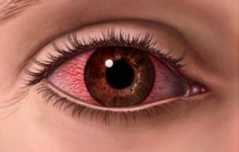 眼球有红血丝的原因（眼球有红血丝是咋回事）