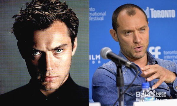 明星也愁发际线 如何拯救男同胞们的头发