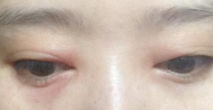 眼睛告诉你的6个健康状态