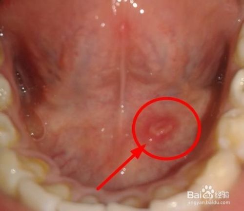 舌底上长了一个类似小舌头的疙瘩怎么办 百度经验