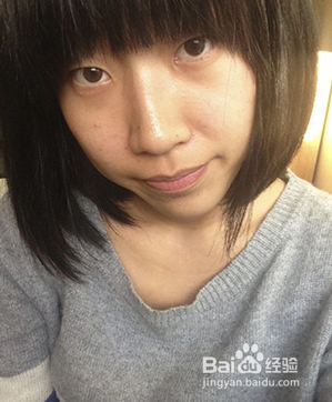 全切双眼皮效果很不错