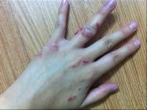 如何使用湿疹膏痔康斋