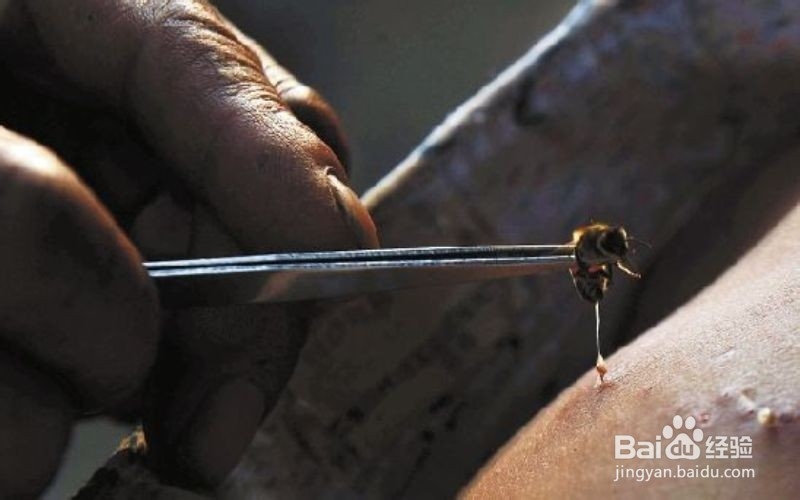 被毒蜂蜇伤怎么办？