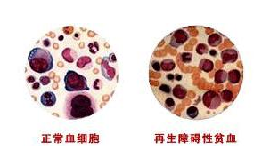 再生障碍性贫血,您该知道的知识