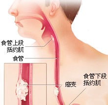 食道癌如何延长生命