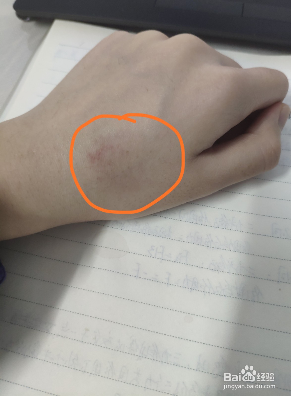 怎么消除草莓印吻痕