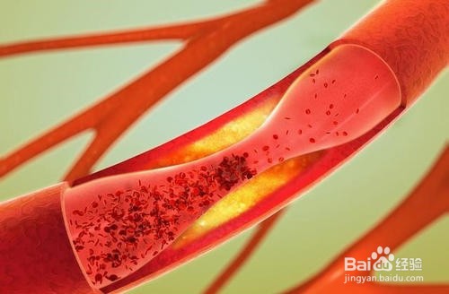 如何预防脑出血