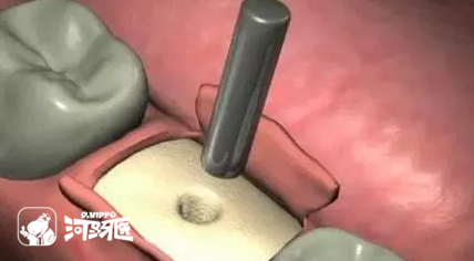 几张图让你看明白种植牙的过程！