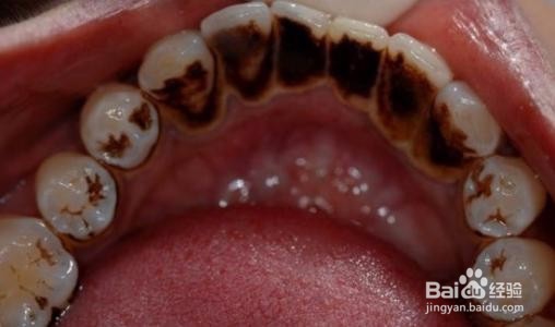 怎么知道有牙石