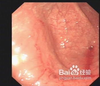 慢性胃炎的早期症状有什么