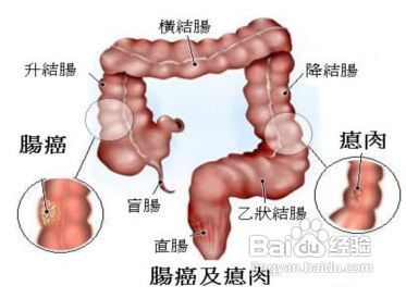结肠癌发病的相关因素是什么