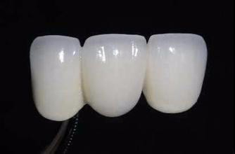 烤瓷牙崩瓷怎么办