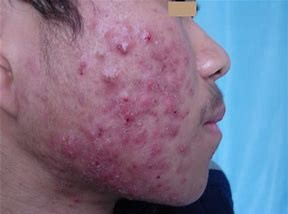 有效的祛痘方法