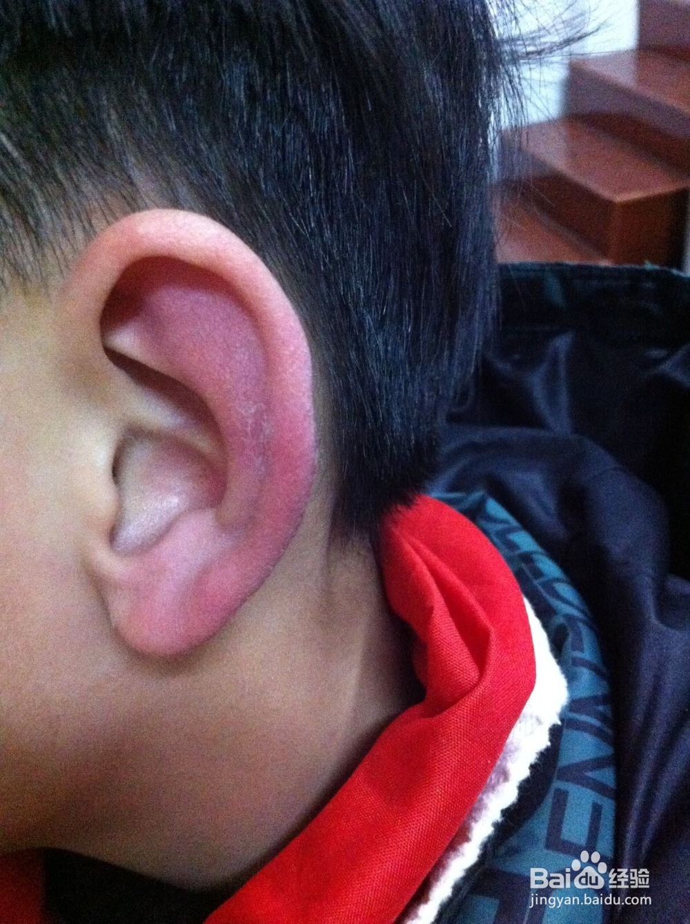 耳朵冻了怎样快点好