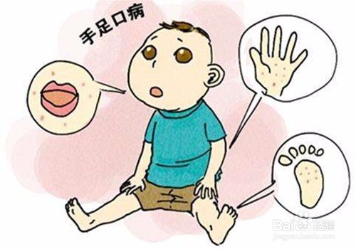 如何防控手足口病