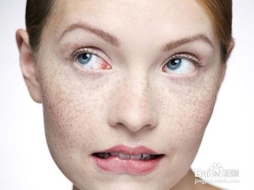 肝斑怎样去除?这6招很管用!