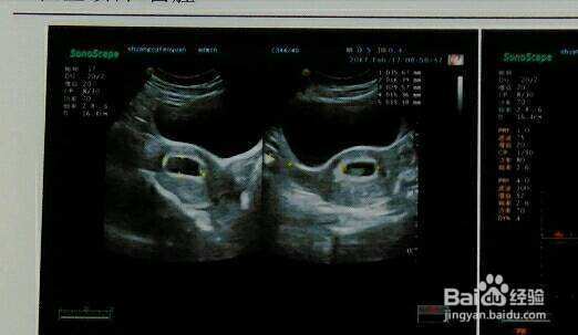 准妈妈备孕及早孕期检查应该注意什么