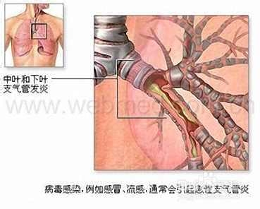 支气管炎的危害有哪些?