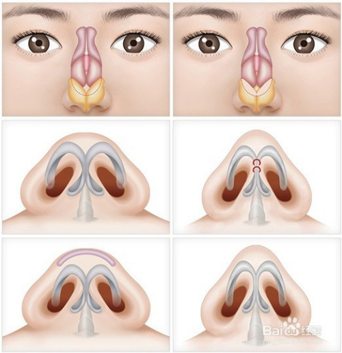 鼻尖整形方法的有哪些