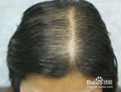 洗头时掉很多头发怎么办