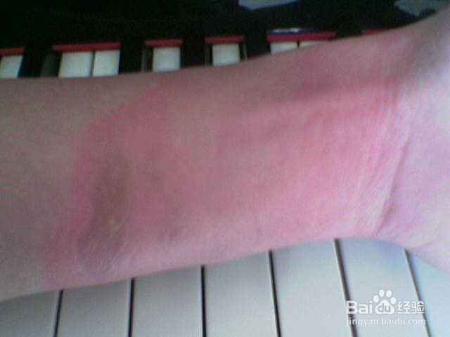 被烫伤怎样不留疤？