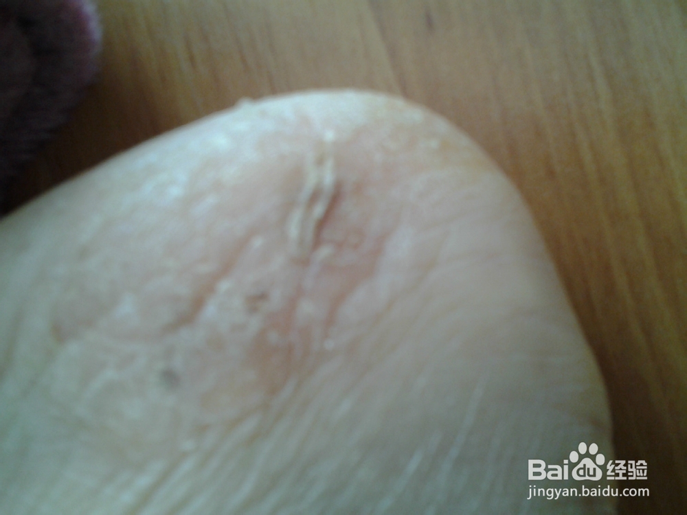 香蕉皮巧治皲裂