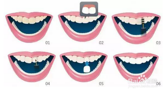 牙齿贴面美白全攻略